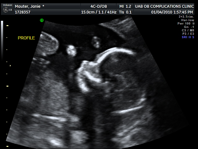 ultrasound of baby's profile